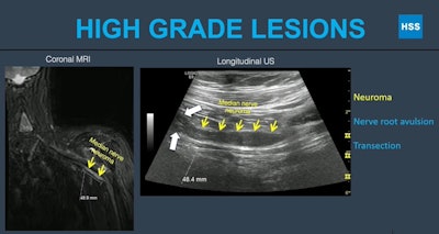 Researchers at the American Roentgen Ray Society (ARRS) annual meeting presented research showing that ultrasound may be used as a complementary modality for diagnostic imaging of the brachial plexus. Here, MRI and ultrasound images show fusiform thickening of the median nerve in a high-grade lesion known as a neuroma. Images and caption courtesy of ARRS.