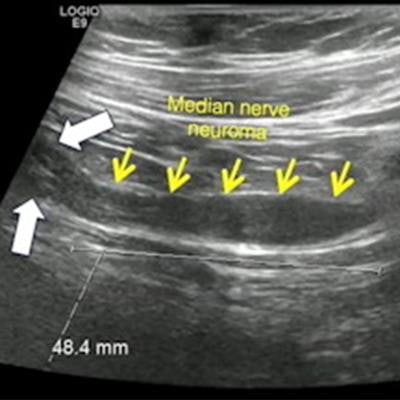 brachial plexus anatomy mri