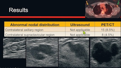 Dr. Huong Le-Petross of the University of Texas MD Anderson Cancer Center presented a study at the ARRS annual meeting on April 18 recommending PET/CT imaging as a first-line approach for staging women with inflammatory breast cancer. Image and caption courtesy of Dr. Le-Petross.