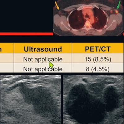 inflammatory breast cancer ultrasound