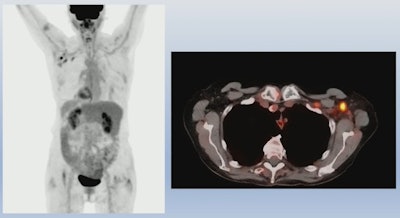 An example of PET/CT imaging from the study of a cancer patient who received the Pfizer-BioNTech COVID-19 vaccine showing FDG radiotracer uptake in the shoulder (left) and axial lymph node activity in the fused PET/CT image (right). Image courtesy of Dr. Mehemet Adin.