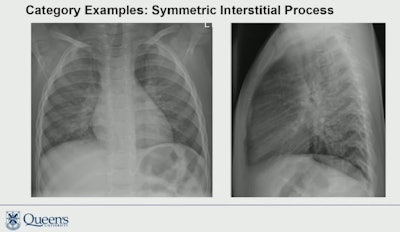 Dr. Michael Kurtz of Queen's University in Toronto, Ontario, presented a study showing that symmetric patterns of lung infiltrates on chest x-rays can help identify viral cases in children. Image courtesy of Dr. Kurtz.