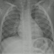2023 04 26 18 07 6935 2023 04 26 Cxr Pneumonia 20230426180926