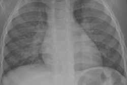 2023 04 26 18 07 6935 2023 04 26 Cxr Pneumonia 20230426180926