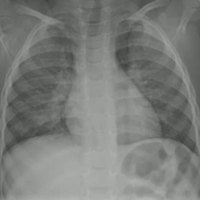 2023 04 26 18 07 6935 2023 04 26 Cxr Pneumonia 20230426180926