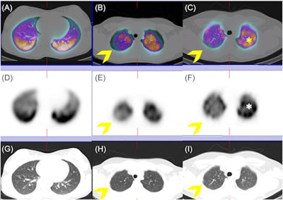 Lung SPECT/CT scans with technetium-99m (Tc‐99m) macroaggregates (MAA) in three children with long COVID-19. No significant lung perfusion alterations were detected in a patient with long COVID-19 symptoms (A, D, F) on both axial hybrid images and functional slices (A, D). Conversely, imaging showed an area of mild hypoperfusion in the apical segment of the right upper lobe, clearly evident on both axial fused and functional slices in another patient (B, E; arrow). Finally, an area of moderate hypoperfusion was detected on a third patient, clearly evident on hybrid imaging, as well as on the functional slices (C, F; arrow), which is associated to a diffuse and heterogenous distribution of radiotracer in both lung parenchyma (*). All these abnormal findings do not correspond to parenchymal alterations on coregistered CT images (G, H, I). Image and caption courtesy of Pediatric Pulmonology through CC BY 4.0.