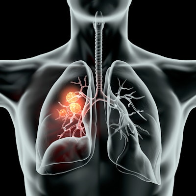 2021 02 04 17 15 7107 Cancer Lung 3 D Black 400