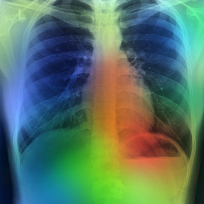 chest xray cancer