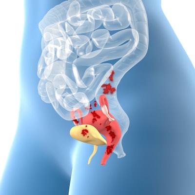 2022 12 22 00 38 7923 Endometriosis 3 D Illustration 400