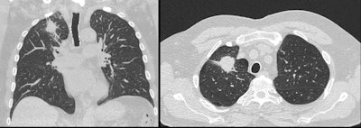 The Heart of Australia team diagnosed this former miner with lung cancer and emphysema using Philips’ Precise Image AI reconstruction app.