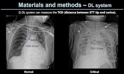 A slide presented by researchers at the ARRS meeting in Hawaii showed measurements used by an AI model for detecting correct endotracheal tube placements in x-rays of intensive care unit (ICU) patients. Image courtesy of Dr. Eui Jin Hwang.