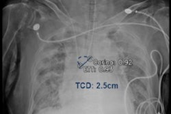 2023 04 28 18 42 9820 2023 05 01 Ai Tube Placement 20230428185946