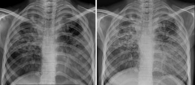 Chest x-ray images for the same individual with evidence of tuberculosis using (A) the Mine 2 machine, and (B) a standard digital x-ray machine. Image courtesy of the Indian Journal of Medical Research through CC BY 4.0.