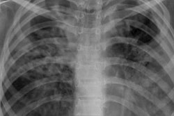 2023 05 01 20 02 3187 2024 05 02 Cxr Tb 20230501204404