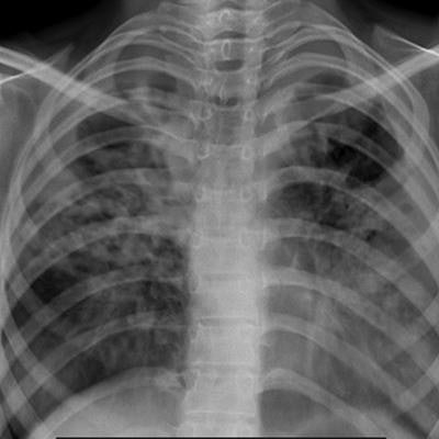 tuberculosis vs pneumonia x ray