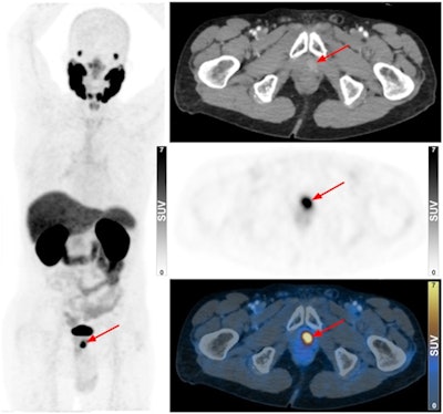 Ga-68 PSMA-11 PET/CT of an 84-year-old man (no biopsy) with rising PSA levels. Focus of increased uptake was identified at left apex of prostate (arrow), indicating localized disease. Image courtesy of the Journal of Nuclear Medicine through CC BY 4.0.