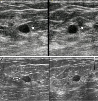 Images of a 37-year-old woman show a palpable mass due to low-grade ductal carcinoma in situ (DCIS). (A) Orthogonal portable ultrasound images show a hypoechoic oval mass with subtly indistinct margins (arrows), assessed as probably benign by artificial intelligence (AI). (B) Orthogonal standard-of-care ultrasound images show focal microlobulation (arrow) and were assessed as suspicious with AI and as BI-RADS 4A by the radiologist. Ultrasound-guided core biopsy and excision showed estrogen and progesterone receptor positive low-grade DCIS. Images courtesy of RSNA.