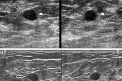 2023 05 01 23 54 1593 2023 05 02 Ai Breast Ultrasound 20230501234818