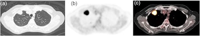 Representative images of a 69-year-old woman with mutated EGFR lung adenocarcinoma. (a) CT image showing a mass in the right upper lobe. (b) FDG-PET and (c) PET/CT fusion images showing intense uptake in the tumor (maximum standardized uptake value [SUVmax] = 16.8, correlation = 0.1, gray-level nonuniformity for run [GLNUr] = 6.86, run length nonuniformity [RLNU] = 136.6, coarseness = 0.033, long-zone high gray-level emphasis [LZHGE] = 5223, and gray-level nonuniformity for zone [GLNUz] = 4.25). Image and caption courtesy of Scientific Reports through CC BY 4.0.