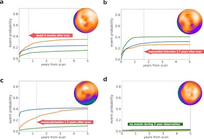 Individual prediction of event probability in four different patients: (a) A 58-year-old male with no history of coronary artery disease (CAD), stress total perfusion deficit (TPD) of 2%, and diabetes; (b) A 76-year-old male with a history of percutaneous coronary intervention (PCI) and coronary artery bypass grafting (CABG), stress TPD of 3%, and family history of CAD and dyslipidemia; (c) A 63-year-old male with no history of CAD, stress TPD of 20%, and no other risk factors; (d) A 60-year-old male with no history of CAD, stress TPD of 1% and no risk factors. Curves represent predicted cumulative event probability of death (orange lines), acute coronary syndrome (green lines), and revascularization (blue lines) as a function of time. The vertical dashed lines mark the time of the true event. Image and caption courtesy of npj Digital Medicine through CC BY 4.0.
