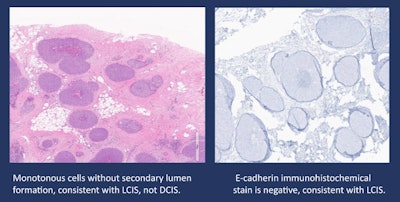 Pleomorphic lobular carcinoma in situ and ductal carcinoma in situ may be confused from each other as was the original pathology interpretation in this case of a 50-year-old woman presenting with suspicious imaging findings on DBT and subsequent ultrasound. Researchers from the University of Texas MD Anderson Cancer Center said these can be differentiated by the use of immunohistochemical stain which shows lack of E-cadherin. Image and caption courtesy of Dr. Hannah Chung.