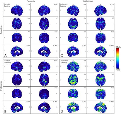 Parametric maps of amyloid deposition in healthy control participants (A and B) and blast-exposed military instructors (C and D) at baseline (A and C) and follow-up (B and D). The blue-to-red scale indicates the frequency of statistically abnormal amyloid uptake in a particular brain voxel. Whereas no abnormal amyloid uptake was identified at baseline or follow-up in healthy control participants (A, B), amyloid deposition occurred most frequently in blast-exposed participants in the superior parietal lobules, precuneus, cingulum, paracentral lobules, and anterior temporal and occipital lobes (D). Image and caption courtesy of Radiology.