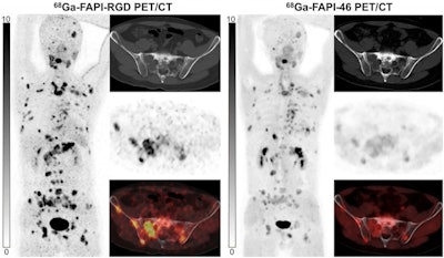 Ga-68 FAPI-RGD PET/CT shows significantly higher radiotracer uptake than Ga-68 FAPI-46 in patient with metastatic thyroid cancer. Image courtesy of the Journal of Nuclear Medicine through CC BY 4.0.