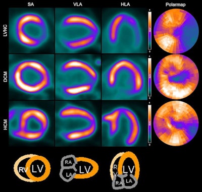 Example of Ga-68 FAPI-04 PET images in representative patients. LVNC = Left ventricular noncompaction; DCM = Dilated cardiomyopathy; HCM = Hypertrophic cardiomyopathy; SA = Short axis; HLA = Horizontal long axis; VLA = Vertical long axis; RV = Right ventricle; LV = Left ventricle; RA = Right atrium; LA = Left atrium. Image and caption courtesy of EJNMMI Research through CC BY 4.0.
