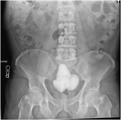 A KUB (kidney, ureter, and bladder) x-ray showing gigantic bladder calculi in a 60-year-old patient with known chronic urinary retention. Image and caption courtesy of Urology Case Reports through CC BY 4.0.