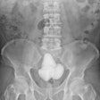 2023 05 12 01 55 2851 2023 05 10 X Ray Bladder Stones 20230512010250