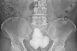 2023 05 12 01 55 2851 2023 05 10 X Ray Bladder Stones 20230512010250