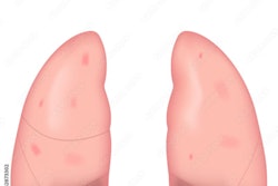 2023 05 12 17 36 5609 Lung Fibrosis 400