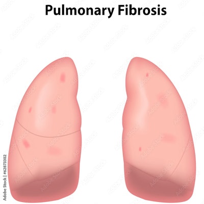 2023 05 12 17 36 5609 Lung Fibrosis 400