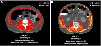 (A) Unenhanced axial abdominal CT image with a Hounsfield unit-based color scale of skeletal muscles in a 51-year-old man with obesity, smoking history, no type 2 diabetes, and no history of cardiovascular events at inclusion shows mild fatty infiltration in the muscles (myosteatosis, yellow), with most voxels in the positive range of Hounsfield units (red). The patient was lost to follow-up after 13.2 years. (B) Unenhanced axial abdominal CT image with a Hounsfield unit–based color scale of skeletal muscles in a 53-year-old man with obesity, smoking history, no type 2 diabetes, and no history of cardiovascular events at inclusion shows severe fatty infiltration in the muscles (myosteatosis, yellow), mostly distributed in the paravertebral (i.e., erector spinae and multifidus) and oblique muscle groups. The patient died after 9.4 years of follow-up. Image and caption courtesy of the RSNA.