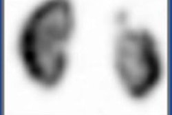 2023 05 16 21 06 3117 2023 05 16 Spect Renal Kids 20230516212924