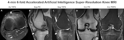 Knee MRI in a 30-year-old man with knee pain. The five-sequence MRI was acquired within four minutes through sixfold combined parallel imaging and simultaneous multislice acceleration, deep-learning image reconstruction, and artificial intelligence super-resolution. The arrows in A-C indicate an osteoid osteoma of the anterior tibia with surrounding bone edema. Image courtesy of Dr. Jan Fritz, NYU Langone Health.
