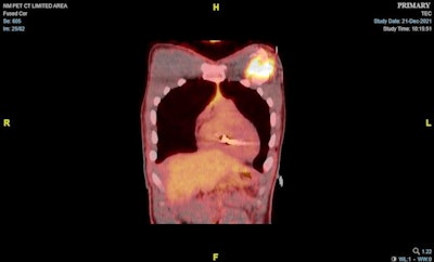 A PET/CT image demonstrating evidence of increased FDG activity posterior to the cardiac conduction device along the anterior left pectoralis major muscle related to inflammation. Image and caption courtesy of HeartRhythm Case Reports through CC BY 4.0.