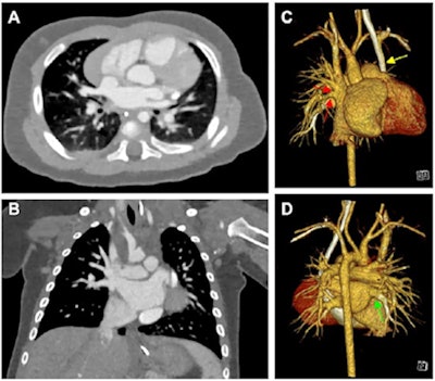 Cardiac photon-counting CT (PCCT) in a 174-day-old male infant with complex congenital heart defect. (A) Contrast-enhanced axial PCCT image shows sonographically suspected sinus venosus defect with partial anomalous pulmonary venous connection. Soft-tissue window is shown with a 0.6-mm section thickness. Intravenous contrast agent amount: 8 mL of iopromide. (B) Contrast-enhanced coronal PCCT image with soft-tissue window with 0.6-mm section thickness. (C) Anterior view of three-dimensional reconstruction shows a partial anomalous pulmonary venous connection of two separate lung veins from the right upper and middle lobe to the right superior vena cava (red arrows) and a persisting left superior vena cava (yellow arrow). (D) Three-dimensional reconstruction, posterior view. The diagnosis was confirmed at PCCT, and PCCT allowed for visualization of the partial anomalous pulmonary venous connection of two separate lung veins from the right upper and middle lobe to the right superior vena cava. One lung vein drains correctly to the left atrium (green arrow). A sinus venosus defect, an atrial septum defect, an enlarged right atrium, and a persisting left superior vena cava are shown. The only regular confluence of a single right lung vein into the left atrium is shown (D; green arrow). Image quality was rated as 5 of 5 (optimal). Dose-length product was 18. Approximated effective radiation dose, 0.58 mSv (conversion coefficient κ = 0.032 mSv/[mGy × cm]). Images and caption courtesy of the RSNA.