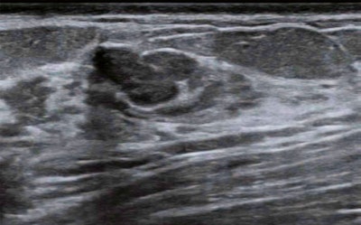 Images from a 52-year-old woman who underwent prior breast ultrasound due to MRI abnormality show a suspicious breast lesion measuring 1.3 cm. Subsequent ultrasound was performed by a radiologist without breast ultrasound expertise for investigational purposes. A) Long-axis gray-scale ultrasound imaging shows a hypoechoic lesion. The lesion was classified by the study radiologist as BI-RADS category 4a. B) Long-axis greyscale ultrasound imaging shows the results of CAD analysis. CAD provided the result of 'possibly benign' for both images. The lesion was therefore downgraded to category 3 based on CAD output. The pathologic assessment based on surgical resection was fibroadenoma. Images and caption courtesy of the American Journal of Roentgenology.
