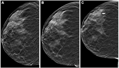 Example images from three successive rounds of DBT show a right craniocaudal tomosynthesis section in a 66-year-old woman screened in (A) 2020, (B) 2021, and (C) 2022 with a new area of architectural distortion identified in 2022 (arrow). This led to a cancer diagnosis. Images courtesy of RSNA.