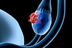 2019 10 15 23 17 6184 Ovarian Cancer 400