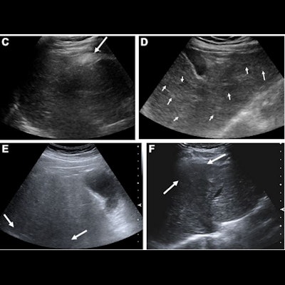 hepatoblastoma ultrasound