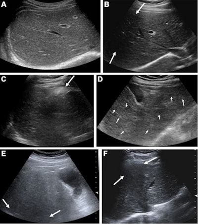 Representative examples of baseline ultrasound images according to the visualization scores and reasons for suboptimal visualization. (A) Visualization A: The liver right lobe was well visualized without any focal lesion with right subcostal scan. (B) Visualization B: With right subcostal scan, the anterior portion of liver right lobe was obscured by shadowing from rib (arrows), and, thus, visualization score B was assigned. (C) Visualization C: With subcostal scan, the liver left lobe and substantial portion of right lobe were not visualized, owing to the shadowing from interposition of the colon (arrow). Because more than half of liver was not clearly visualized, we assigned visualization score C. (D) Suboptimal visualization due to multiple nodules: With subcostal scan, there were multiple subcentimeter size hypo- and hyperechoic nodules (arrows), and, thus, the suboptimal-multiple nodular group was assigned. (E) Suboptimal visualization due to limited penetration: With intercostal scan of liver right lobe, deep portion of liver was obscured (arrows), owing to the limited penetration from fatty liver, and, thus, suboptimal-limited penetration group was assigned. (F) Suboptimal visualization due to limited window: With subcostal scan, the anterior portion of the liver was obscured by shadowing from adjacent rib (arrows), and, thus, suboptimal-limited window was assigned. Images and caption courtesy of RSNA.