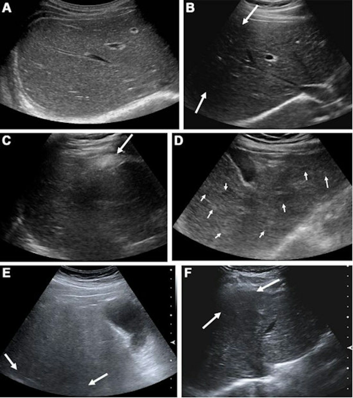 hepatoblastoma ultrasound
