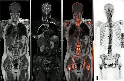 An image presented during a molecular imaging session at the ISMRM meeting in Toronto showing the range of information a hybrid PET/MRI approach provides. Image courtesy of Hersh Chandarana, MD.