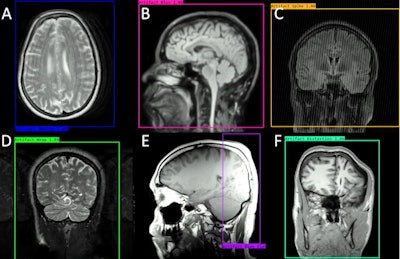 An example of VitaLenz artifact detection, labeling, and location results: (A) motion, (B) blur, (C) RF spike, (D) wrap, (E) bias field, and (F) geometric distortion. Image courtesy of Joel Batey, Philips Healthcare.