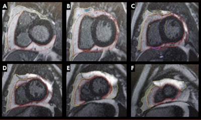 Patricia Maishi presented findings from her team's award-winning study at the ISMRM annual meeting showing ties between antiretroviral therapy use in people living with HIV and adipose deposition affecting cardiac health. The yellow outline represents paracardiac fat volumes while the red outline represents pericardial fat volumes. Image courtesy of Patricia Maishi.