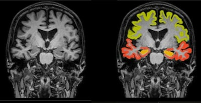Dementia MRI with segmentation. Image and caption courtesy of Icometrix.