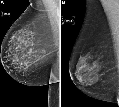 Right medial lateral oblique screening mammograms show negative results from 2016 in (A) a 73-year-old woman with a Mirai AI risk score with more than 90th percentile risk who developed right breast cancer in 2021 at five years of follow-up and (B) a 73-year-old woman with a Mirai AI risk score with less than 10th percentile risk who did not develop cancer at five years after five years of follow-up. Images and caption courtesy of RSNA.
