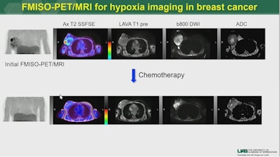 PET/MRI hypoxia imaging in a patient with breast cancer. Image courtesy of Dr. Jonathan McConathy.